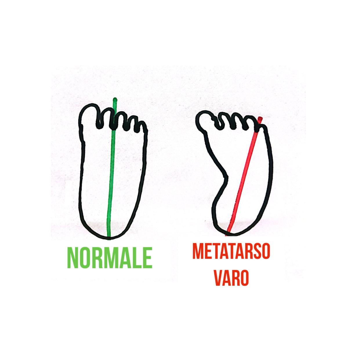 Metatarso varo